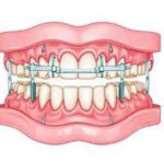 Функциональный или скелетный перекрёстный прикус: почему одинаковая асимметрия требует разного лечения